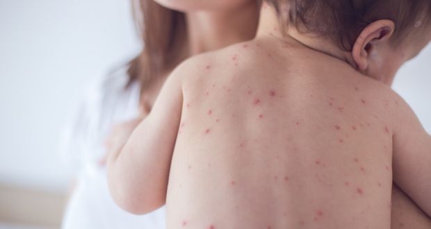 measles baby.jpg
